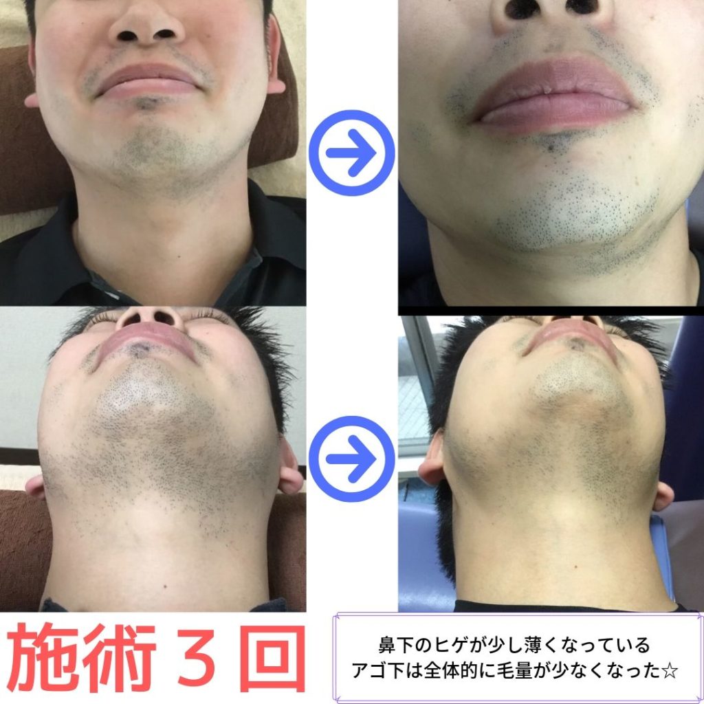 ヒゲ脱毛３回のビフォーアフター写真です